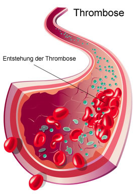 Penisvenenthrombose
