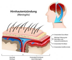 Kopfschmerzen – Hirnhautentzündung (Meningitis)